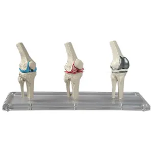 Erler-Zimmer Totální endoprotéza kolenního kloubu, model
